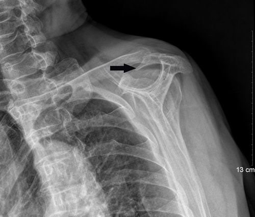 微创技术肩关节镜解决肩病困扰