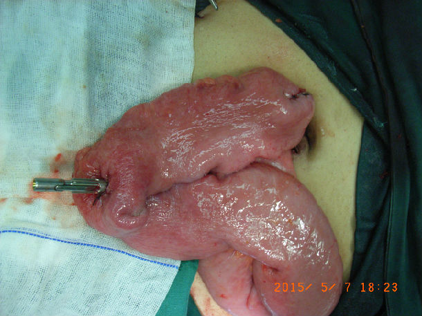 腹腔镜全结肠切除术,回肠储袋-肛管吻合术