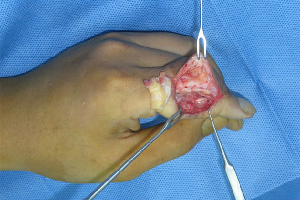 左手食指近侧指间关节陈旧性脱位畸形整形术