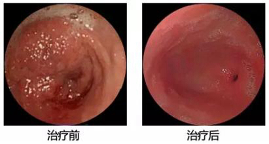 出血性慢性淺表性胃炎治療前后圖片