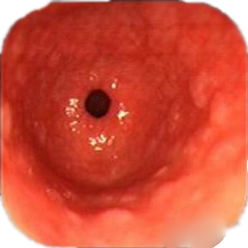 慢性淺表性胃炎胃鏡圖片