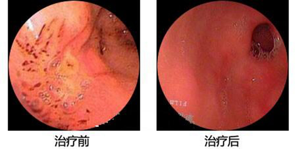 慢性淺表性胃炎治療前后圖片