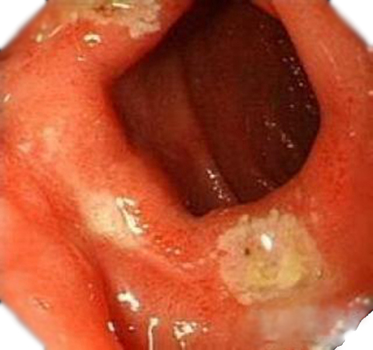 嚴(yán)重潰瘍伴慢性淺表性胃炎圖片