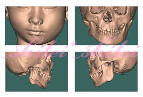 6岁孩子的ct图像,可以很直观地看到不对称的颌骨和发育不良的那侧面部