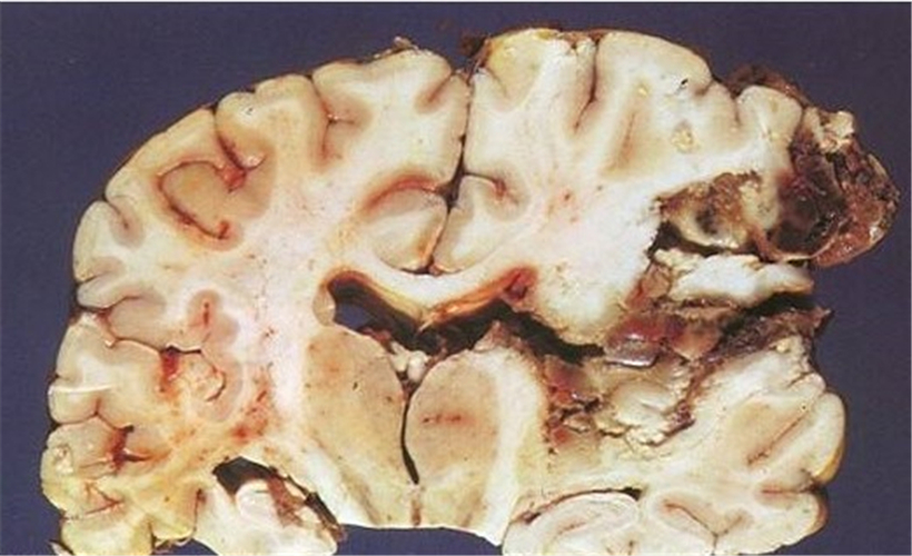 出血性腦梗塞圖片