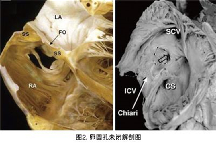 腦梗塞后遺癥期圖片