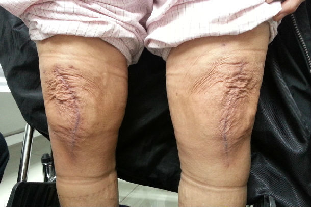 人工膝关节置换手术案例