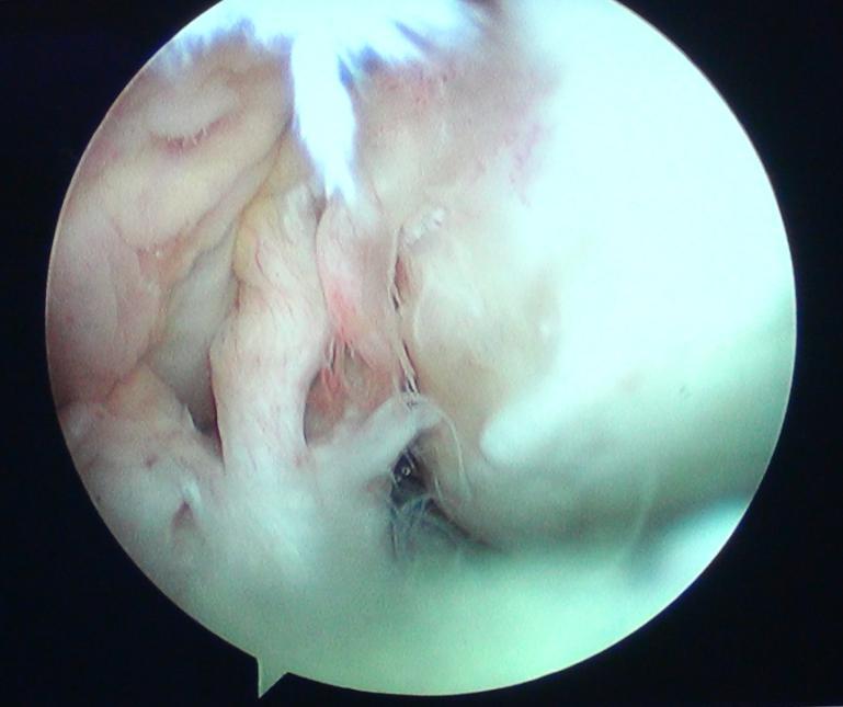 前交叉韧带如何重建?