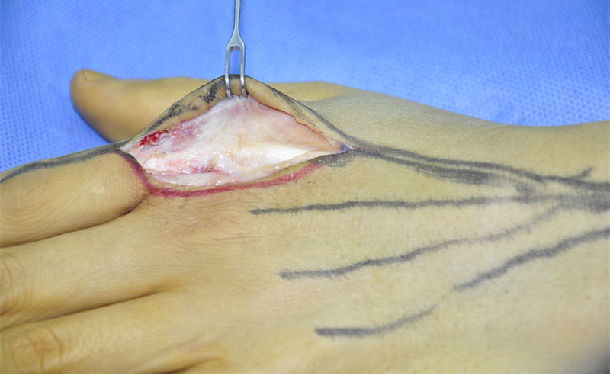 手术设计从背侧入路,主要考虑松解食指伸肌腱与关节囊,近节指骨的粘连