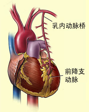 三,传统体外循环冠脉搭桥术