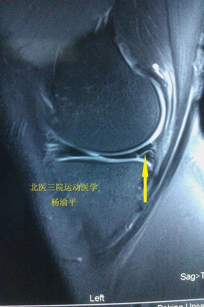 半月板关节镜手术