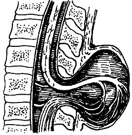 图4 严重的脊髓脊膜膨出(图片均来源于网络)