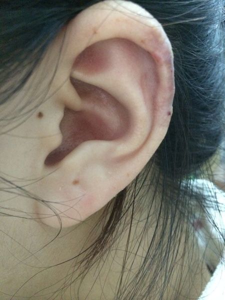 复发型耳廓瘢痕疙瘩的微创治疗