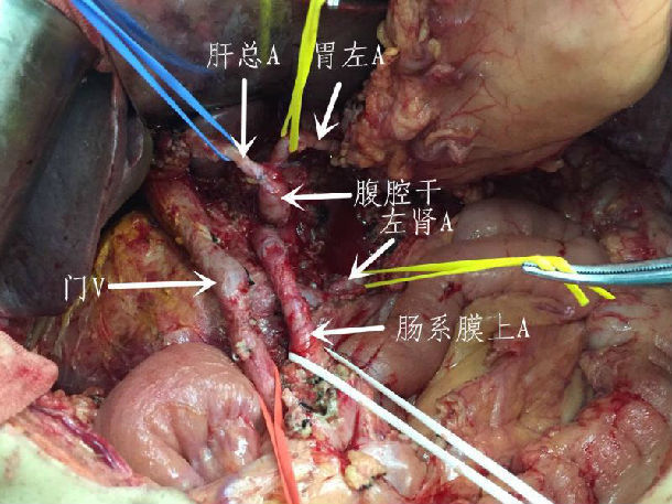 全胰腺切除血管骨骼化处理的病例报告与讨论