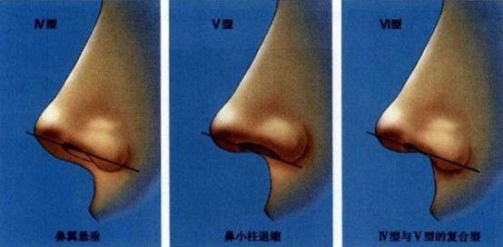 鼻小柱关系的重要性