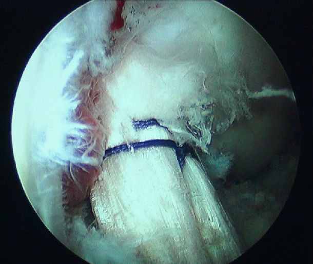 前交叉韧带如何重建?