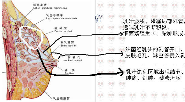 年轻妈妈乳腺脓肿的预防和诊治