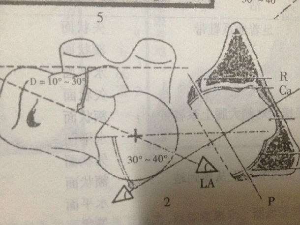 三,如下图所示,股骨头与人体的左右贯穿面呈一个角度,叫做前倾角