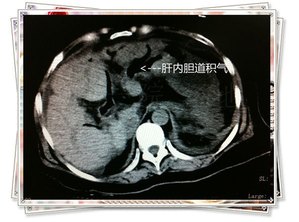 胆道术后胆道内积气是怎么回事?_汤地