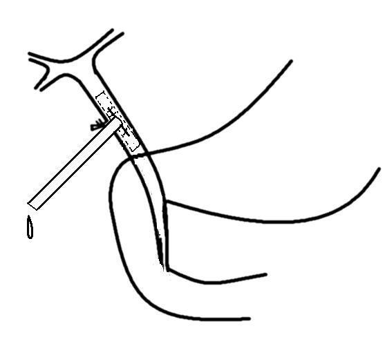 不放t型管的腹腔镜胆总管探查治疗胆总管结石(图示)