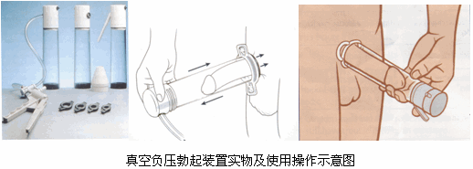 这种方法的优点是非侵犯性疗法,起效快,即时可用,不需手术,注射