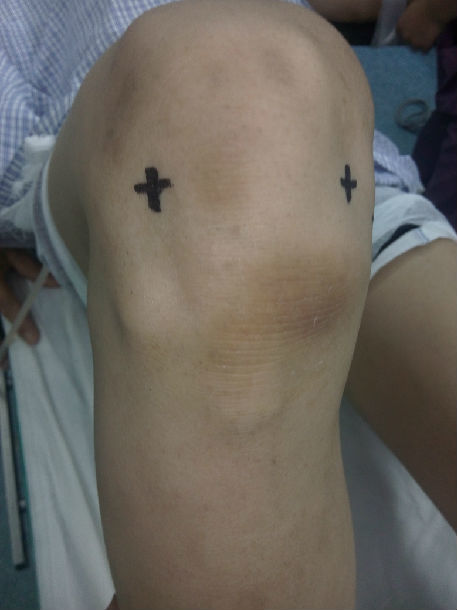 膝关节半月板损伤的关节镜微创手术