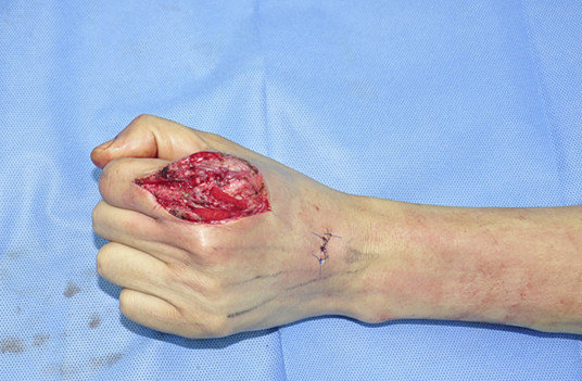 医生文章 详情  从图片可以看到:左手食指伸肌腱粘连导致中末节屈伸