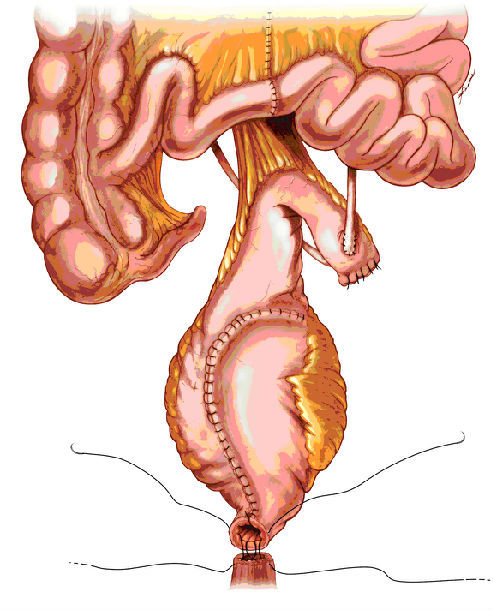 回肠原位新膀胱术后患者的注意事项