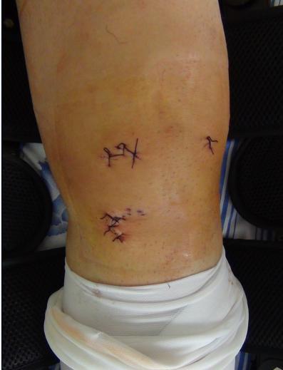 前交叉韧带如何重建?