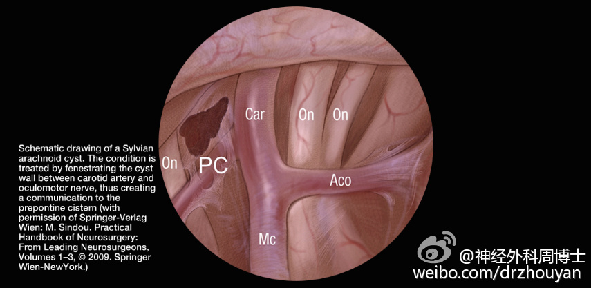 说手术――神经内镜技术】外侧裂蛛网膜囊肿-