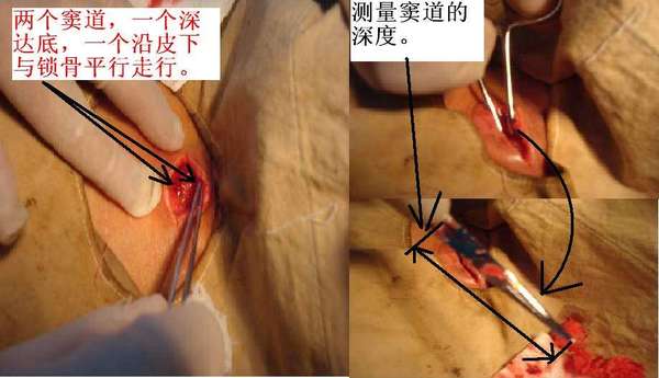 切开引流并腔内填塞换药治疗脓肿型颈淋巴结结核