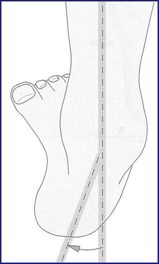 常见的足部畸形有哪些