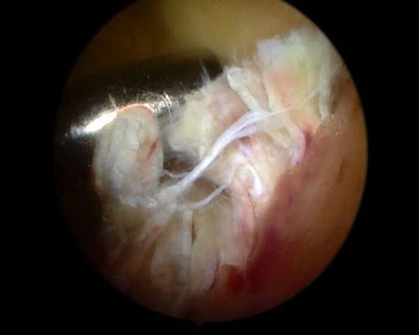 关节镜微创手术治疗前交叉韧带断裂患者!!!