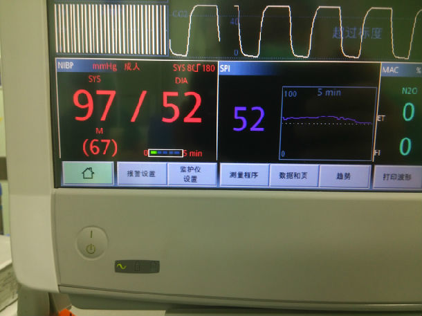 spi定义:   spi(surgical pleth index),ge官网称之为手术体积描计