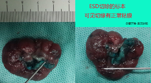 结肠息肉的风险与大小有关但深度更关键