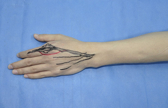 手术设计从背侧入路,主要考虑松解食指伸肌腱与关节囊,近节指骨的粘连