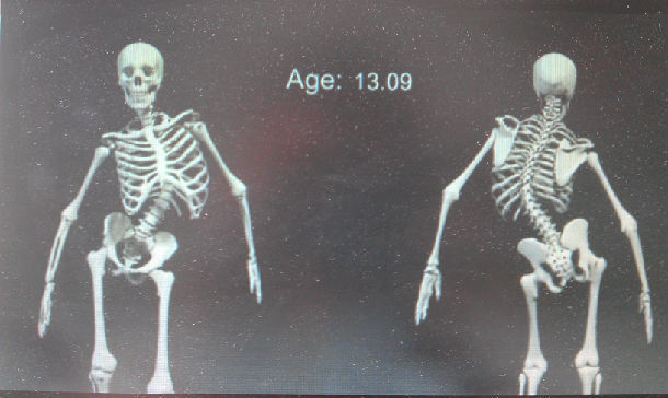 3d骨骼图演示脊柱的变化