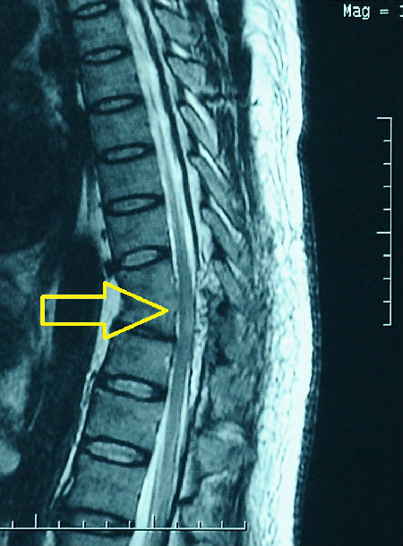 半侧椎板入路微创切除椎管内肿瘤