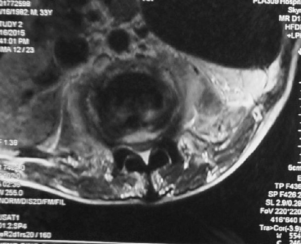 核磁共振显示要2,3椎体结核,椎旁,椎管内脓肿