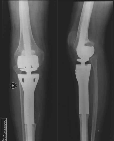 膝关节定制型肿瘤假体的翻修