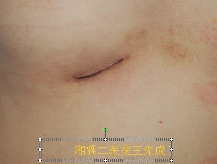 切口大概3cm左右,而且在女性乳房下皱襞处,痕迹非常不明显