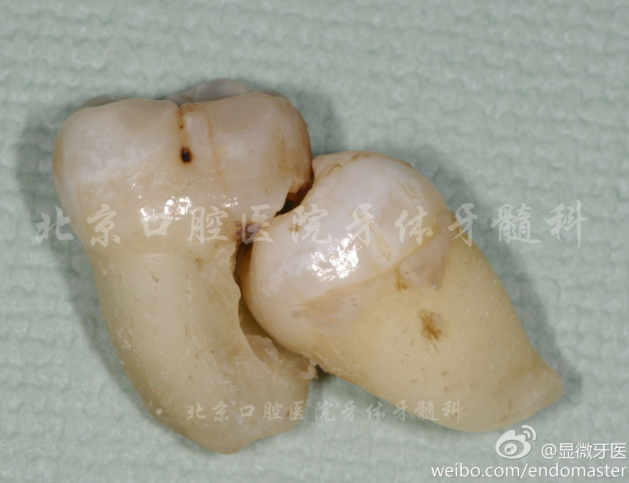 智齿盲袋自己会退吗图片