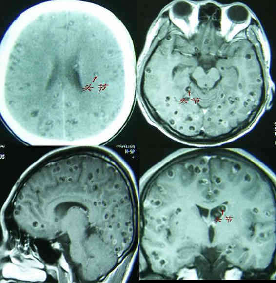 例2: 脑囊虫病(粟粒型)