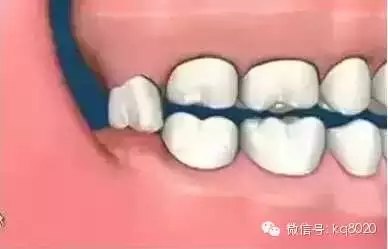 智齿该拔吗?