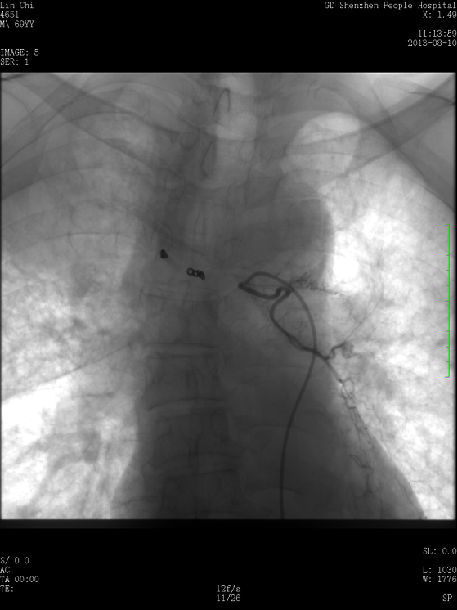 微波消融联合放射粒子植入治疗中央型肺癌
