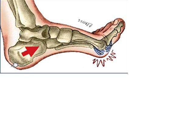 Ⅱ度损伤:    是第一跖趾关节足底关节囊韧带复合体的部分断裂