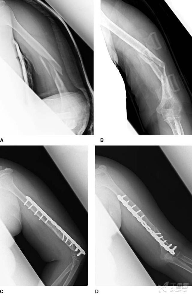 肱骨近端及肱骨干骨折不愈合的治疗