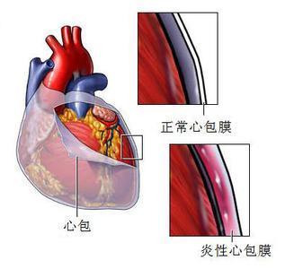 "温润的心"----先心病术后心包积液的原因和处理原则
