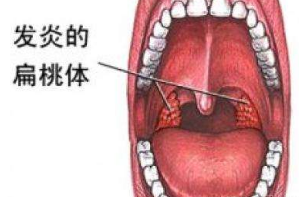 慢性扁桃体炎