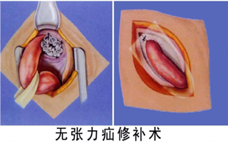 白线疝介绍_白线疝病因_白线疝治疗_白线疝医院医生